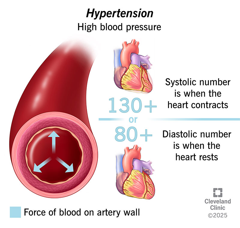 What Causes High Blood Pressure? Common Reasons, Risk Factors & Hidden Causes Explained - medicine