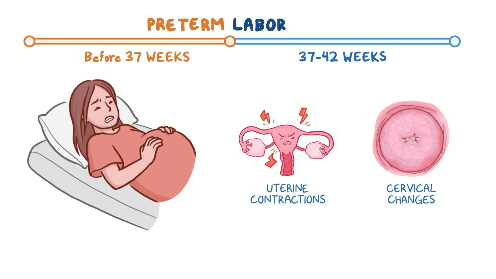 Preterm Labor: Causes, Diagnosis, Prevention and Management - OBSTETRICS AND GYNAECOLOGY