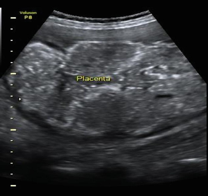Post Term Pregnancy and Fetal Macrosomia Causes Risks Diagnosis and Management - OBSTETRICS AND GYNAECOLOGY